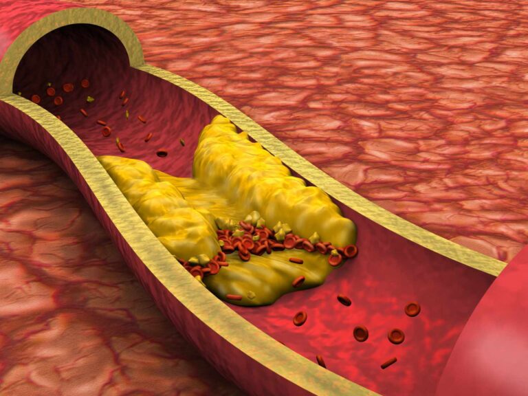Seu Nível de Colesterol LDL Está Realmente Seguro? Entenda Seu Risco Cardiovascular